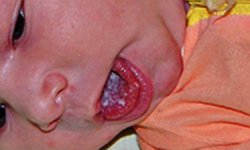 Как лечить молочницу во рту у грудного ребенка – причины появления, симптомы и признаки