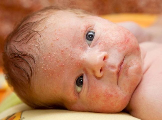 Аллергия у новорождённого на лице