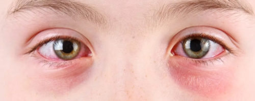 Кораснение слизистых глаз у мальчика