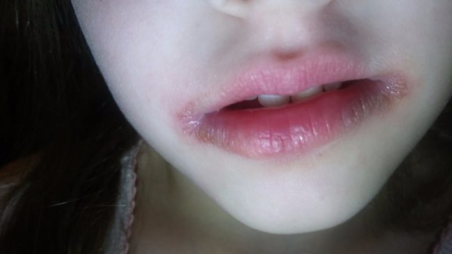 Эрозия на губах при заедах усиливается у ребёнка девочка