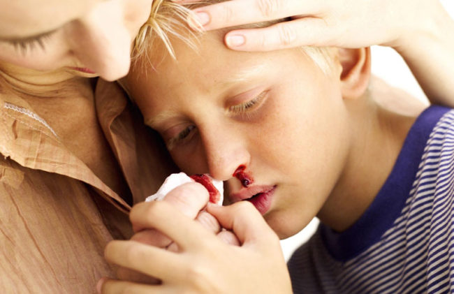 Кровь из носа у ребёнка при сотрясении головы