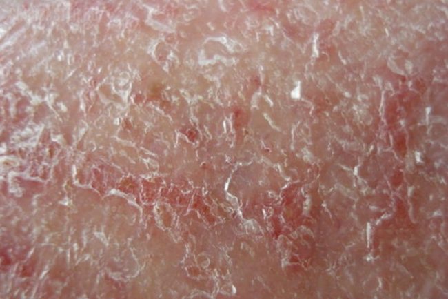 Сухая форма дерматита вблизи на коже