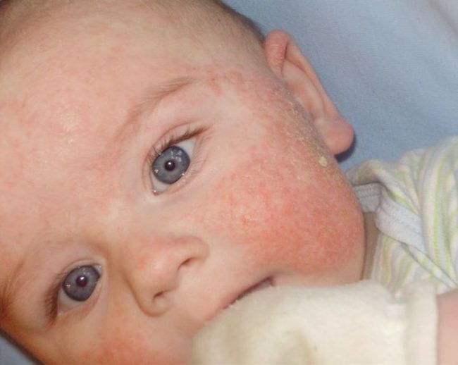 Аллергия на щечках у малыша 