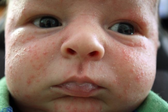 Аллергия на лице у новорождённого