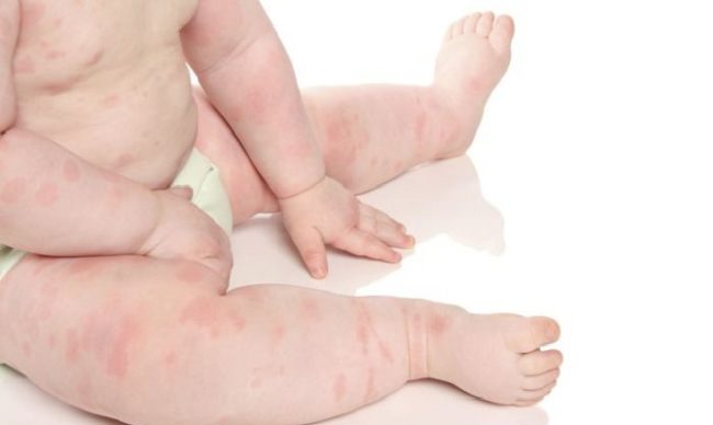 Ручки и ножки новорождённого ребёнка покрыты аллергическими красными пятнами