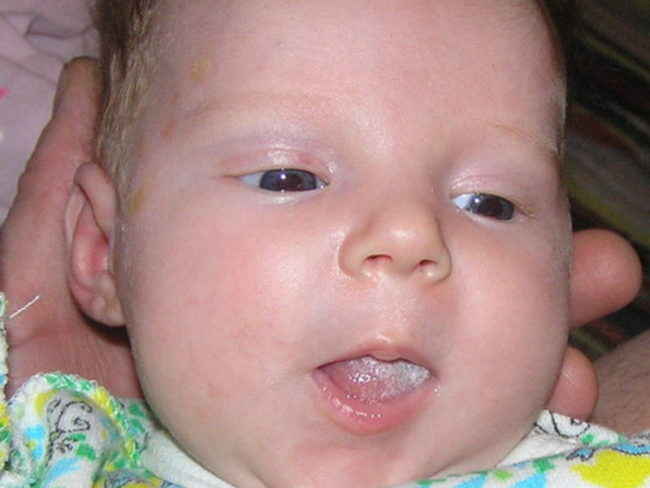 Белый рыхлый налёт у новорождённого на языке