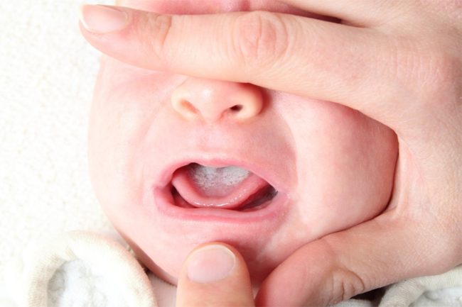 Молочница у новорождённого во рту