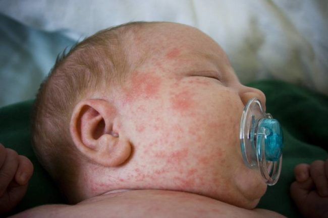 Аллергия у новорождённого
