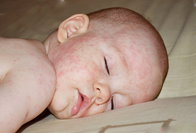 Спящий ребенок с красными пятнами на лице