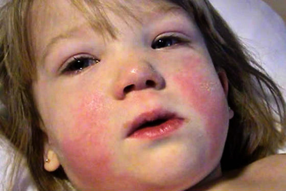 Инфекционный мононуклеоз у ребенка у девочки в виде сыпи