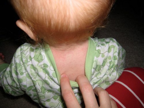 Ребёнок с признаками краснухи на спине