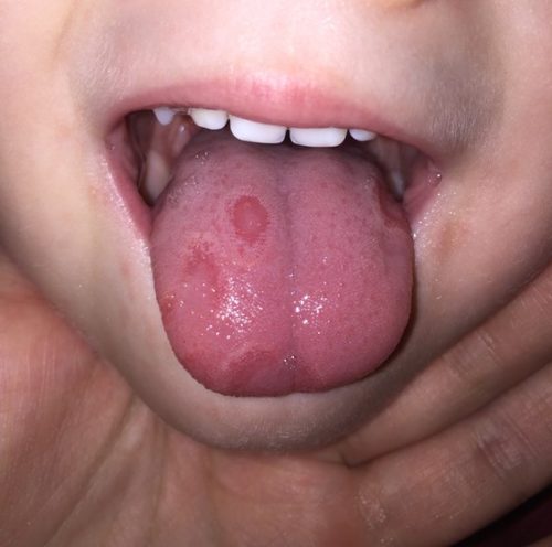 Два пятна и воспалённый язык у ребёнка