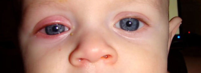 Симптомы конъюнктивита на левом глазу у новорождённого