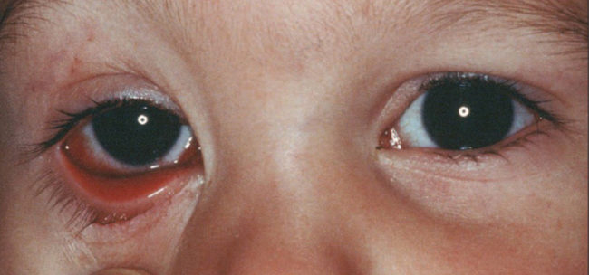 Сильно красные воспалённые глаза при конъюнктивите