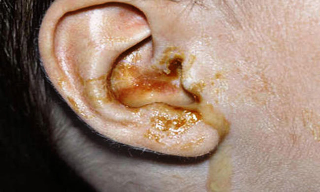 Нагноение из уха при гнойном воспалении и внутреннем отите