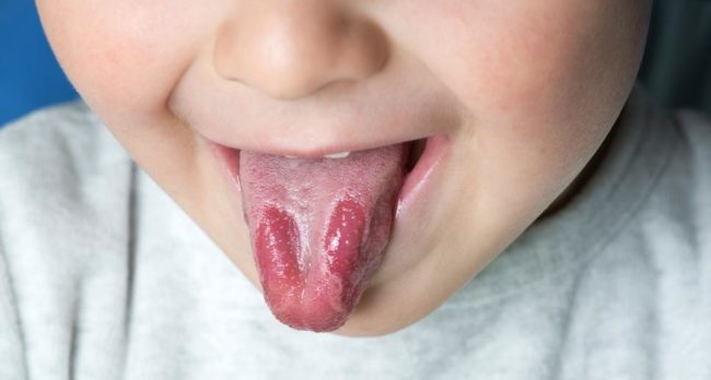Обильные красные пятна по бокам языка у ребёнка