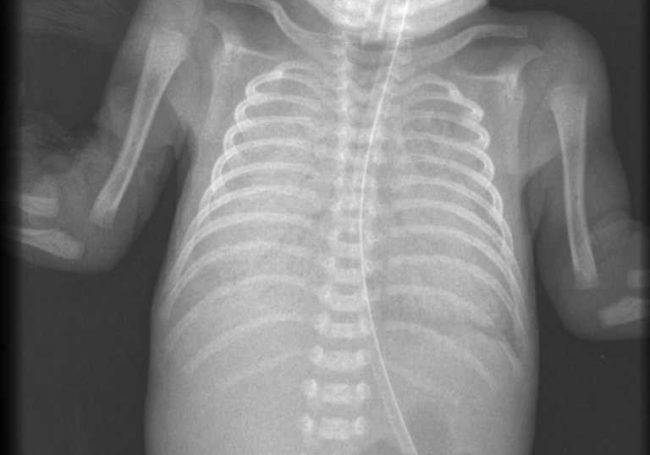 Рентгеновский снимок лёгких у ребёнка два года