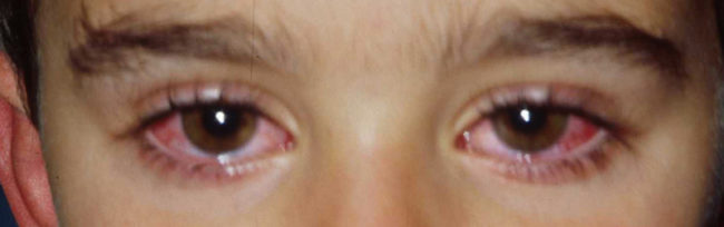 Слезоточивость глаз у ребёнка 7 лет