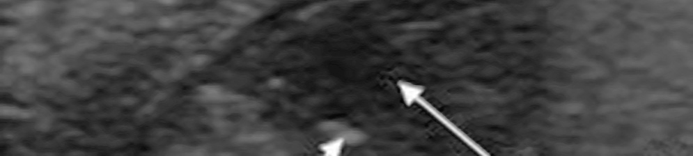 Как лечить пневмонию в домашних условиях у детей: симптомы