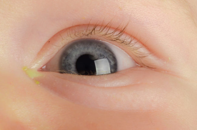 Закисание глаза у ребёнка при конъюнктивите