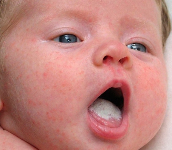 Массивный белый налёт на языке у новорождённого ребёнка