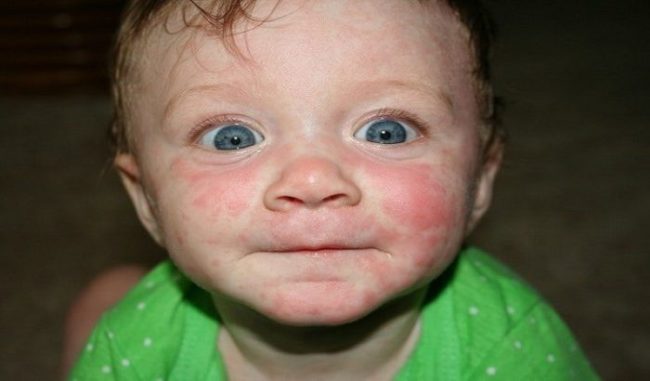 Лицо ребёнка поражённого вирусной экзантемой