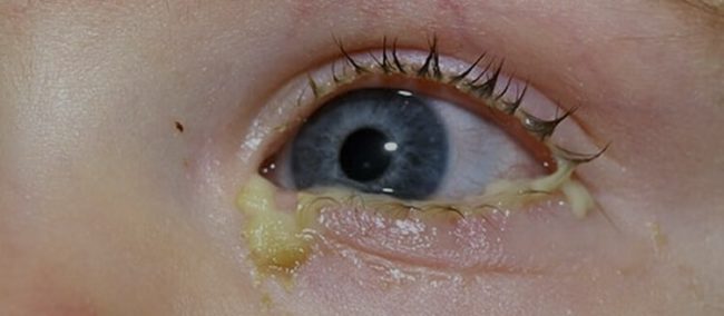Голубой глаз маленького ребёнка с густым зелёным выделением гнойного типа