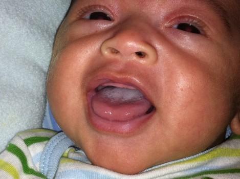 Начало молочницы во рту у новорождённого ребёнка