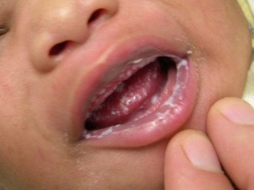 Обильное заволевание и следы молочницы во рту и на губах у новорождённого