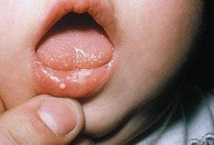 Волдыри при молочнице на губе у малыша