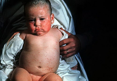 Цитомегаловирус (ЦМВ) у ребёнка на лице