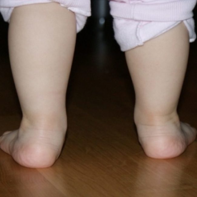 Вальгусная деформация стопы у ребёнка вид сзади
