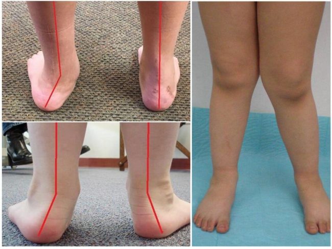 Пример вальгусной деформации стопы у ребёнка