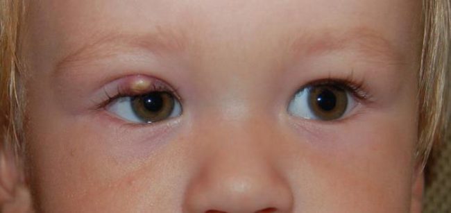 Глаза маленького ребёнка со светлыми волосами и гнойником на верхнем веке