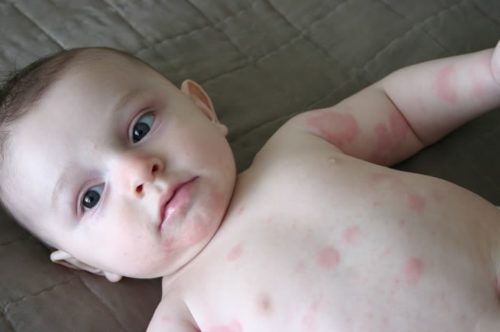 Голенткий ребенок с лежит на кровати, а его теле красные пятна - аллергия