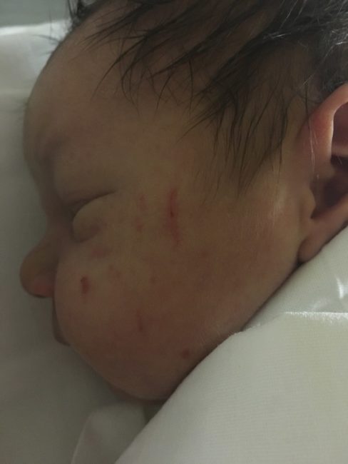 Глубокие царапины на щеке у новорождённого