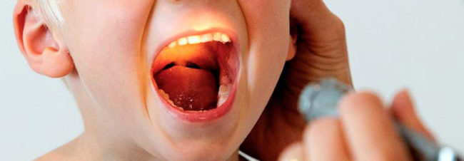 Осмотр красного горла и миндалин у ребёнка врачом