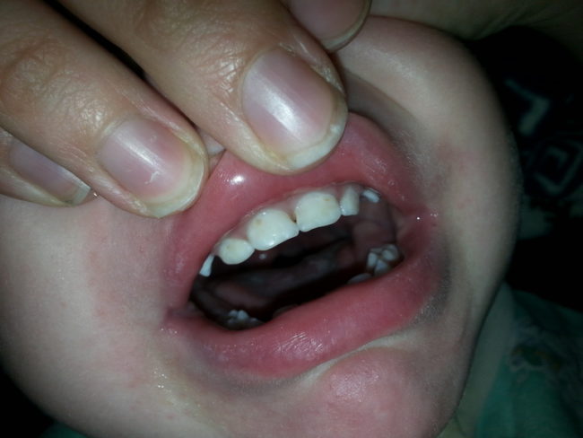 Осмотр молочных зубов у ребёнка