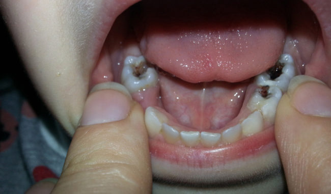 Пульпит на молочных зубах у ребёнка