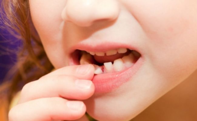 Самостоятельное удаление молочного зуба методом расшатывания