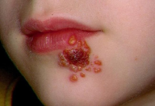 Стрептодермия на лице у ребёнка