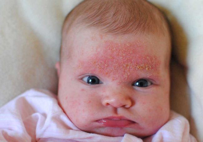 Стрептодермия у малыша на лице на лбу