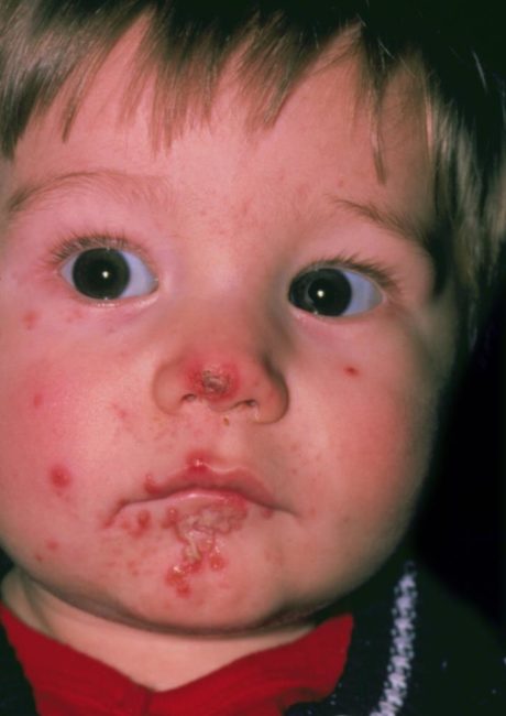 Стрептококковое импетиго на лице у ребёнка