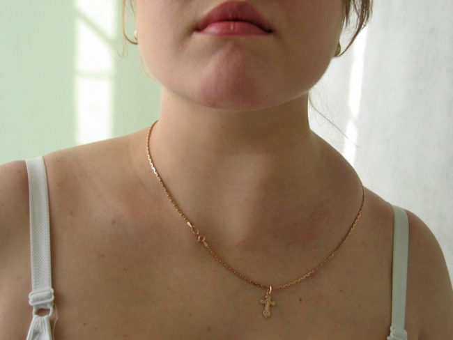 Воспалённые лимфоузлы на шее у женщины