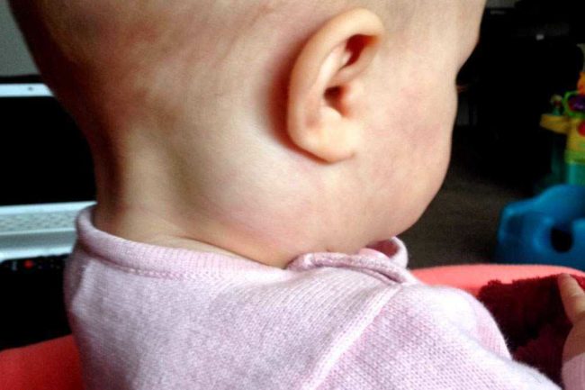 Малыш сидит спиной, за ушком видно, что у него сильно воспалился лимфатический узел