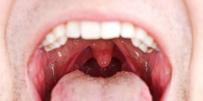 Открытый рот, в котором видно зубы и язык, а также здоровые миндалины, лечить которые нет необходимости