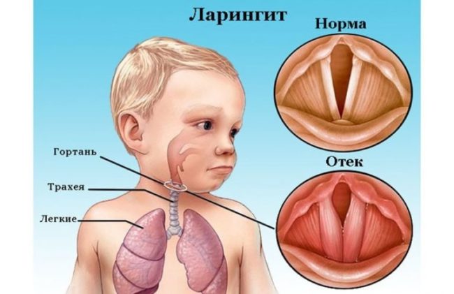 Нормальное горло и с отёком при ларингите у ребёнка