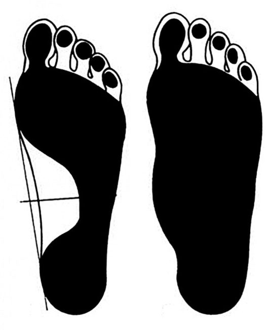 Отпечаток стопы при плоскостопии и здоровые ноги