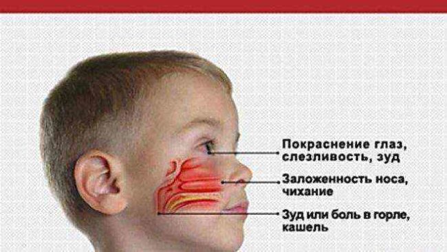 Схема и симптомы ринита у ребёнка схематично
