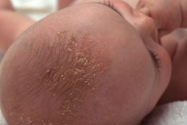 Себорейный дерматит у ребёнка на голове